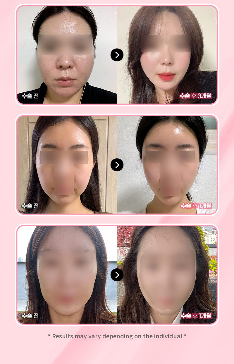 ❤View❤Thermage FLX Lifting