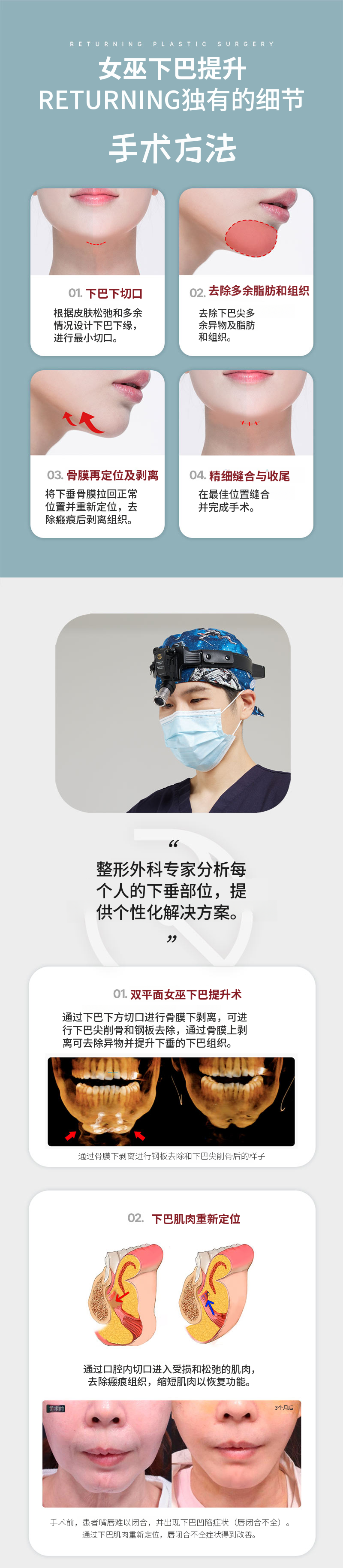 重塑魔女下颌提升