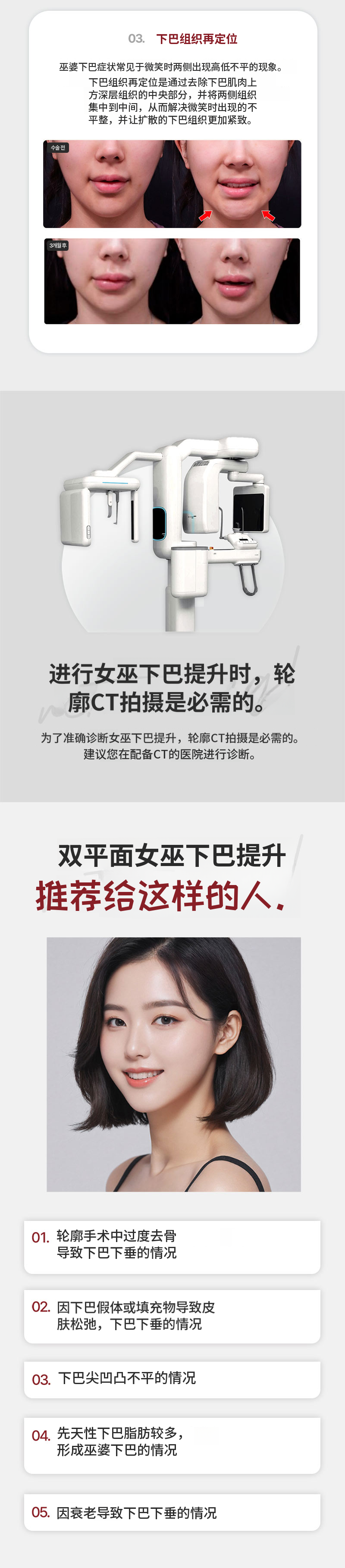 重塑魔女下颌提升