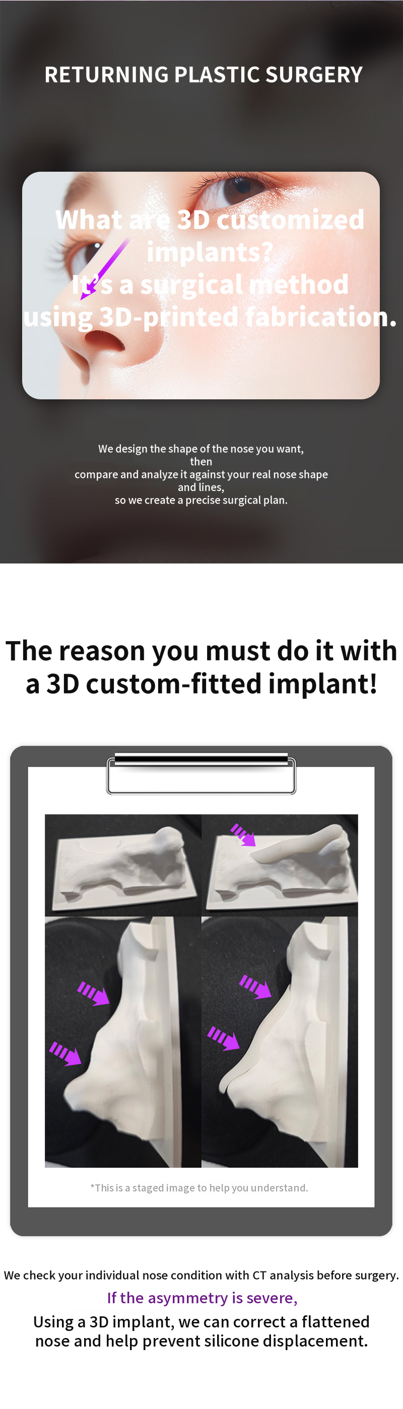 Returning 3D Fit Me Custom Implant