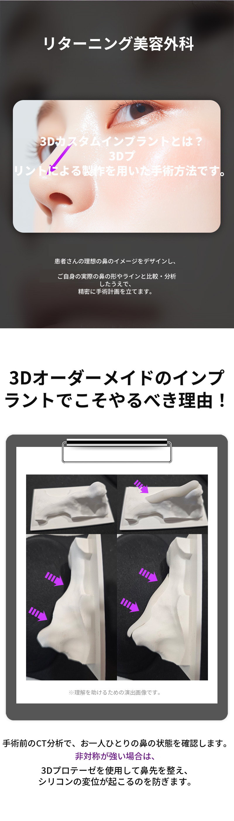 リターニング3Dフィットミコカスタムインプラント