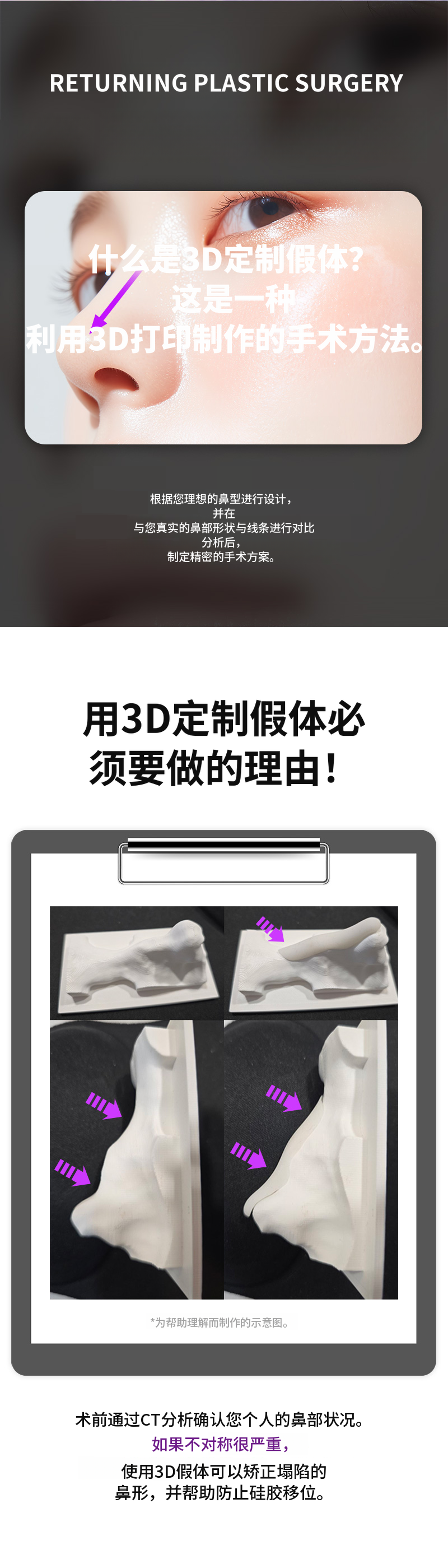 リターニング3Dフィットミコカスタムインプラント