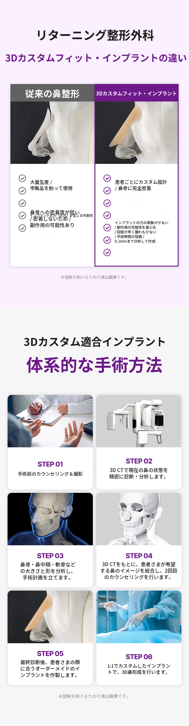 リターニング3Dフィットミコカスタムインプラント