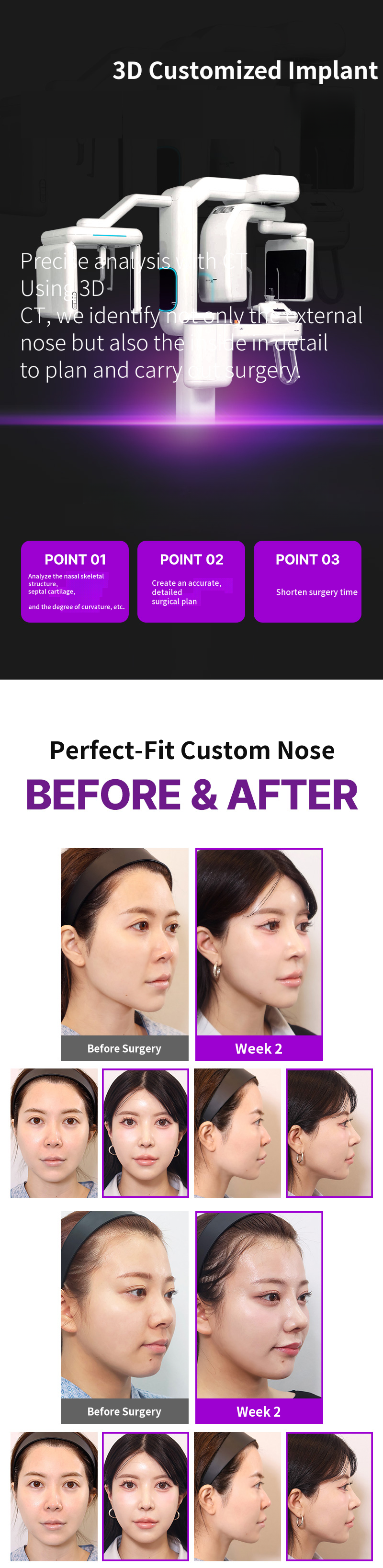 Returning 3D Fit Me Custom Implant
