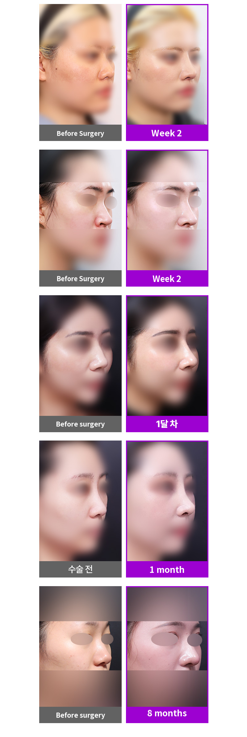 Returning 3D Fit Me Custom Implant