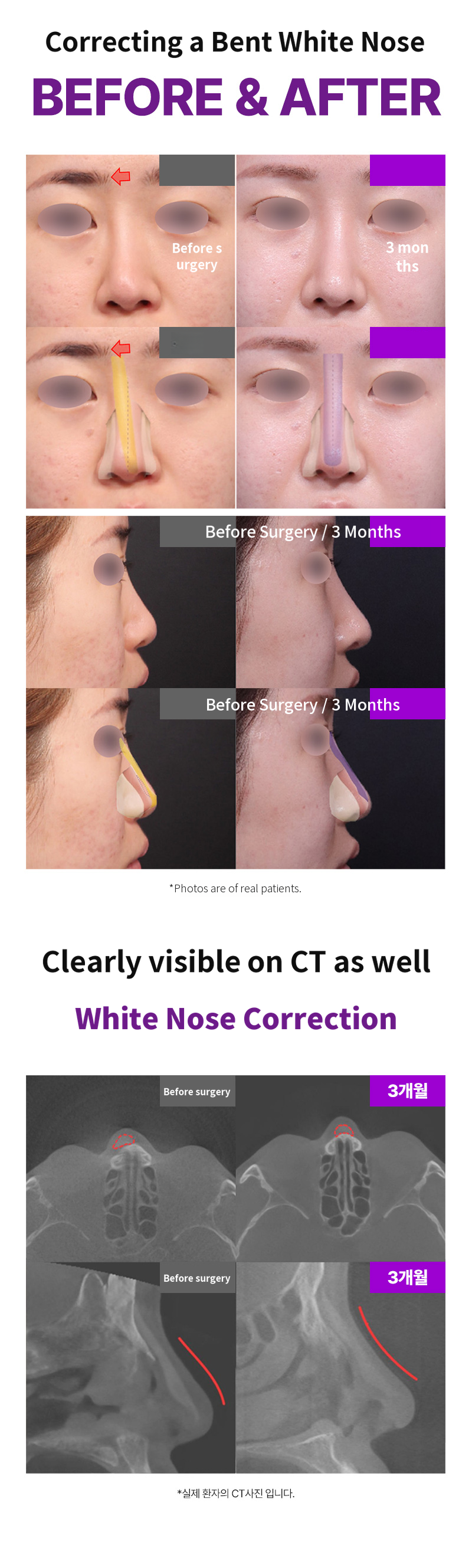 Returning 3D Fit Me Custom Implant