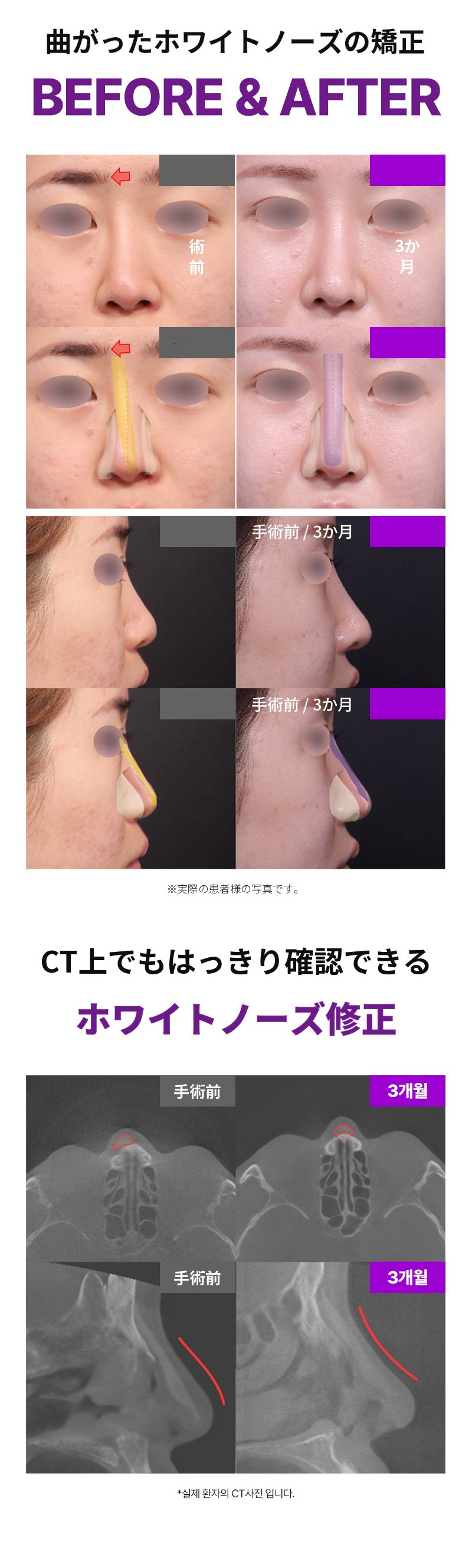 リターニング3Dフィットミコカスタムインプラント
