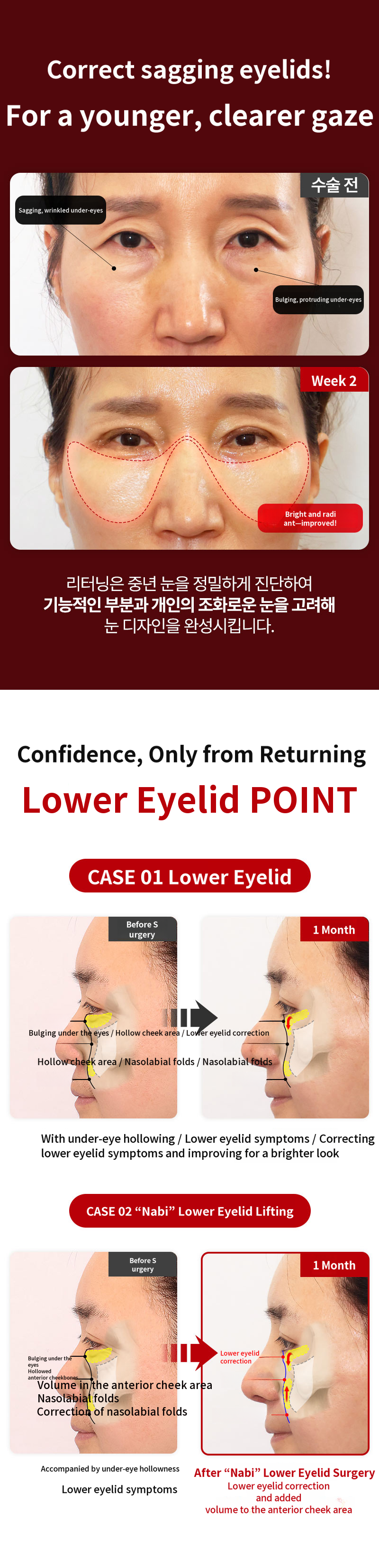 Lower Blepharoplasty