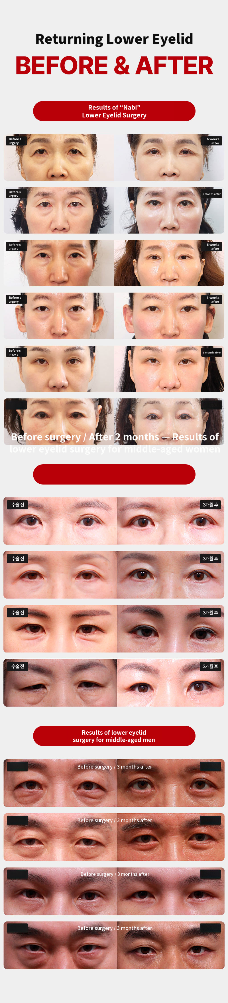 Lower Blepharoplasty