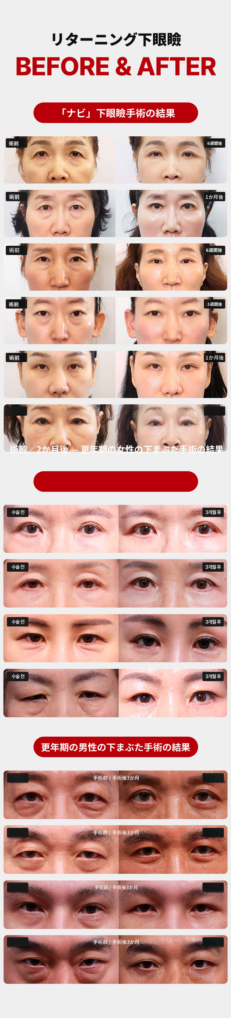 リターニング下眼瞼