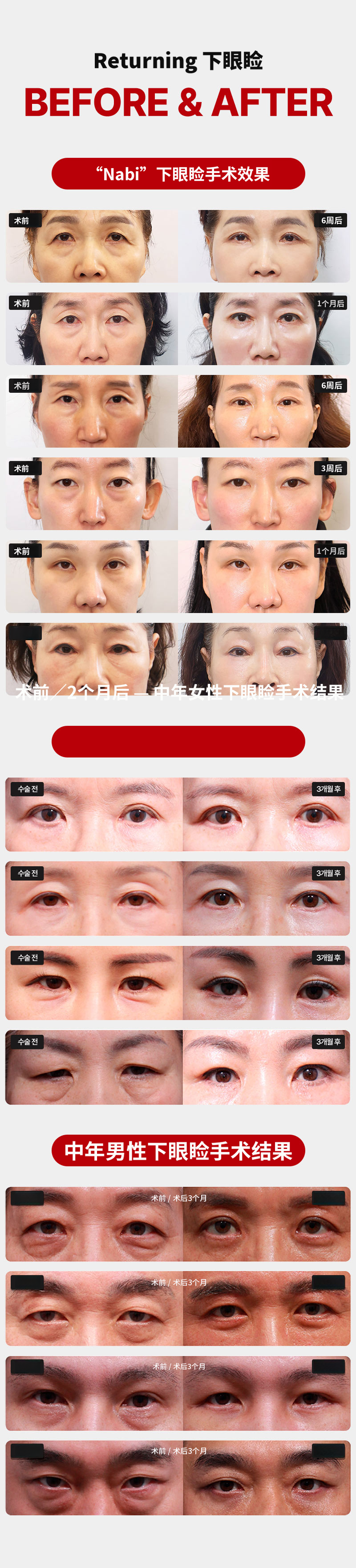 重塑下眼睑