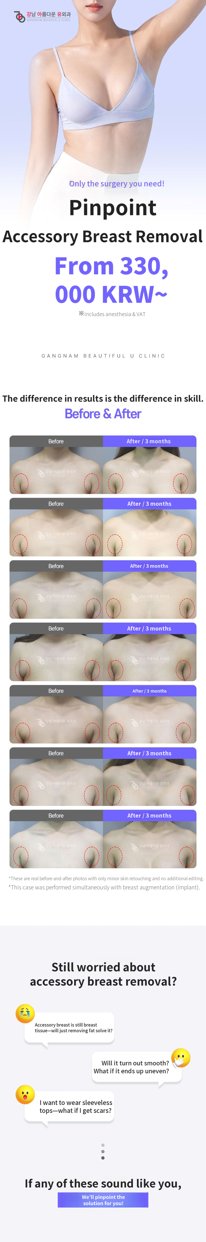 Axillary accessory breast pinpoint removal