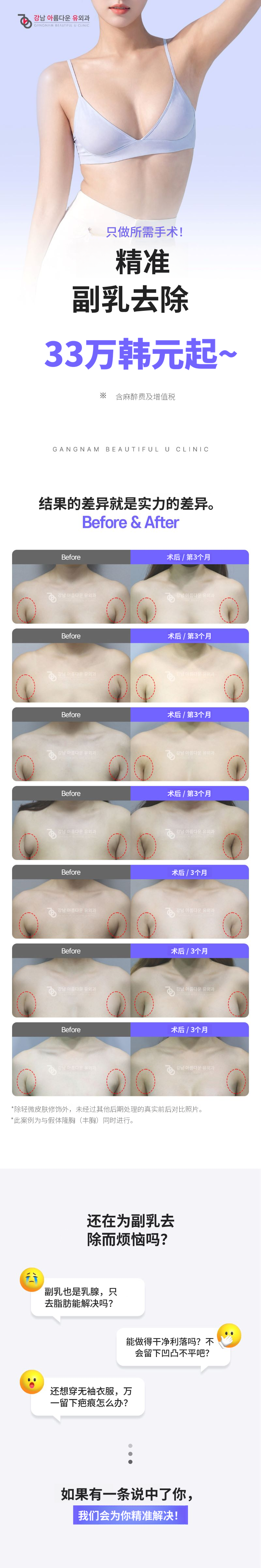 腋下乳腺小点去除