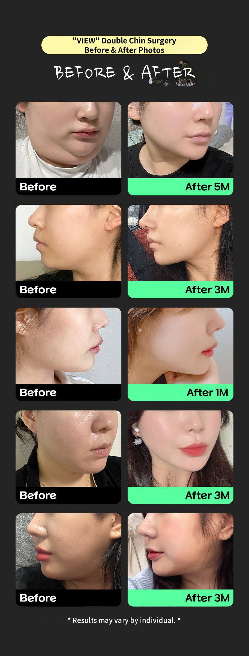 ❤View❤Facial Liposuction