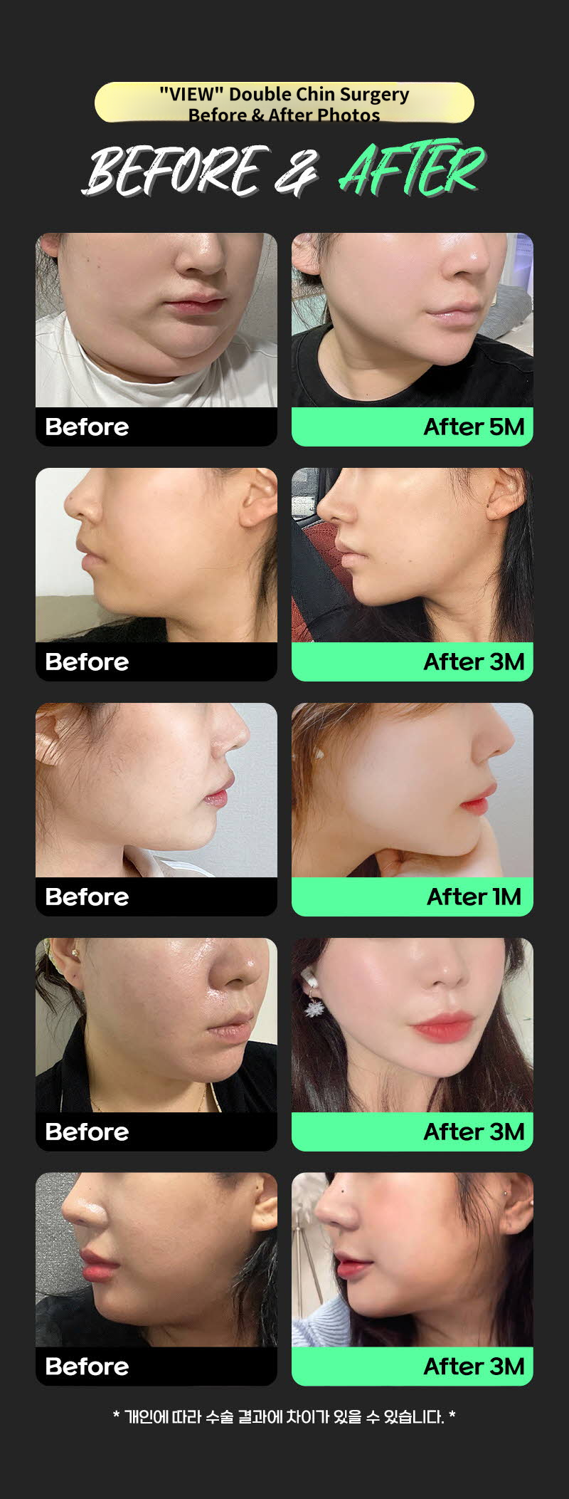 ❤View❤Facial Liposuction