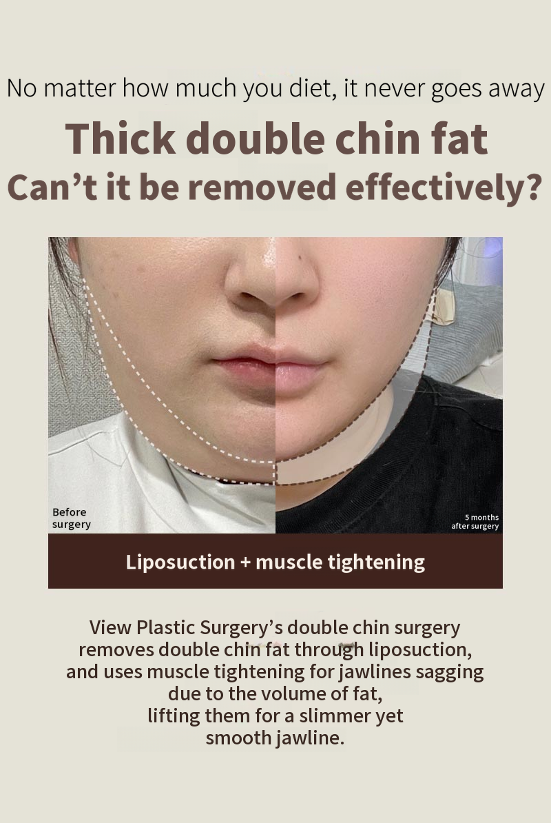 ❤View❤ Facial Liposuction