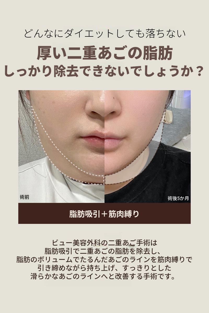 ❤ビュー❤顔の脂肪吸引