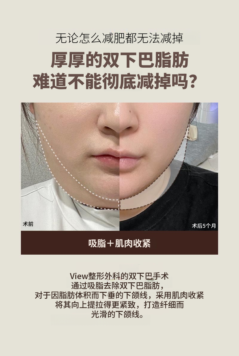 ❤美❤面部吸脂