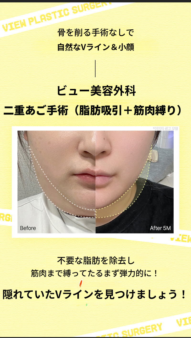 ❤ビュ❤顔脂肪吸引