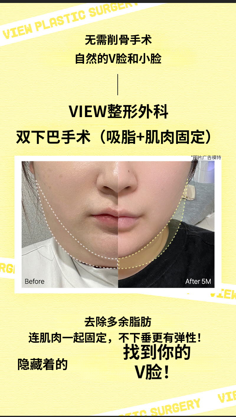 ❤视图❤面部抽脂