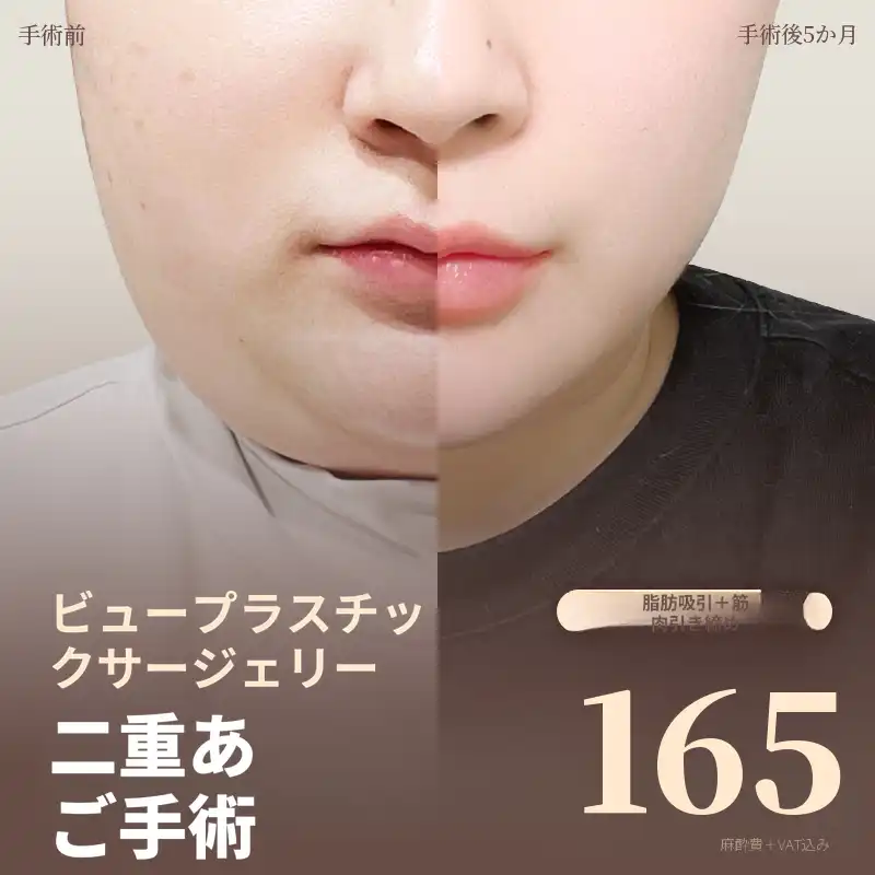 ❤ビュー❤顔の脂肪吸引