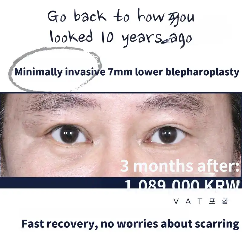 Minimal incision_7mm lower eyelid surgery