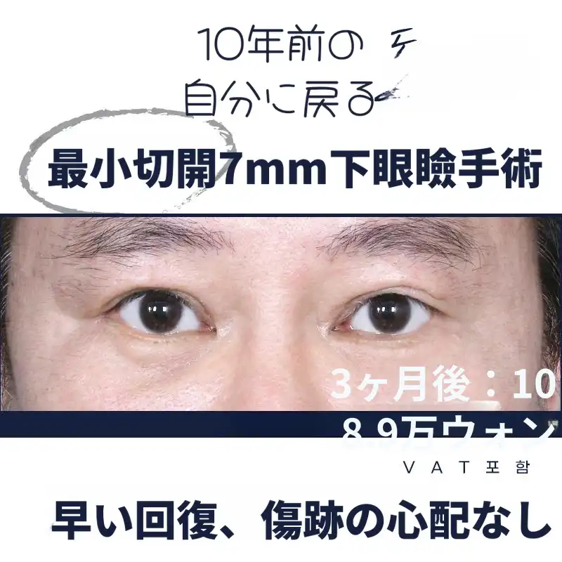 最小切開_7mm 下眼瞼手術