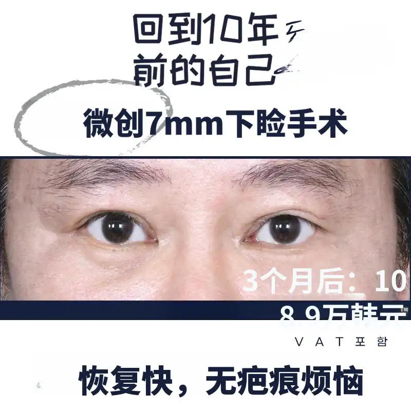 最小切口_7mm 下眼睑手术