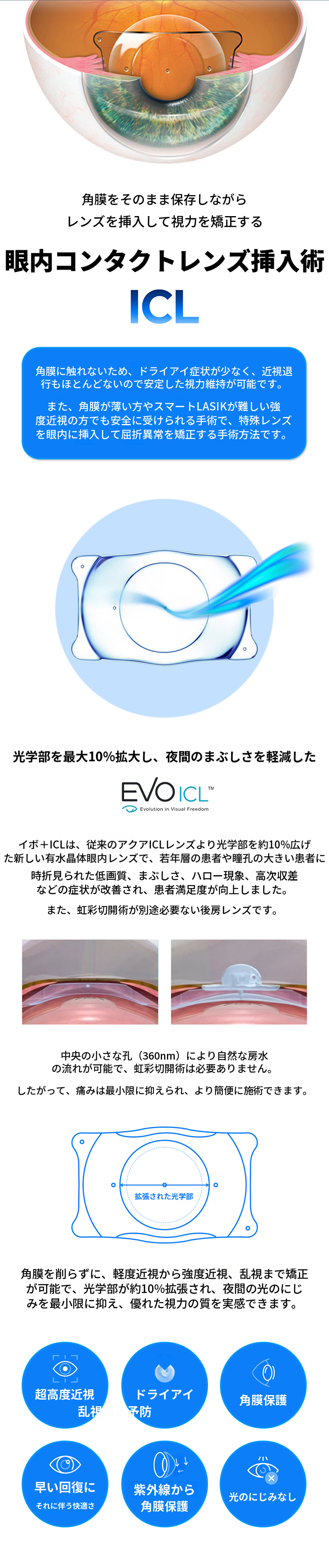 明るさ共有レンズ挿入術 ICL