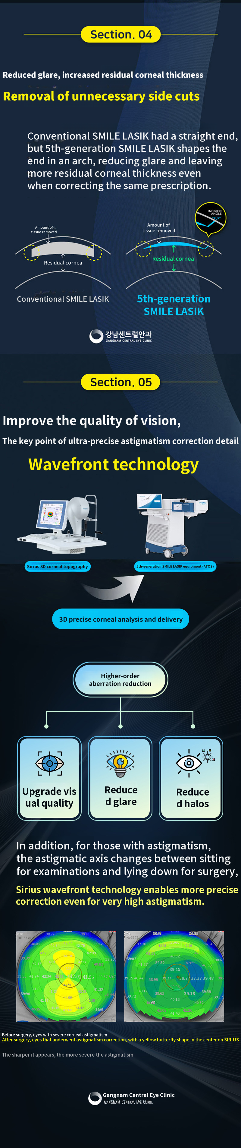 Personalized 5th Generation Smart Smile LASIK