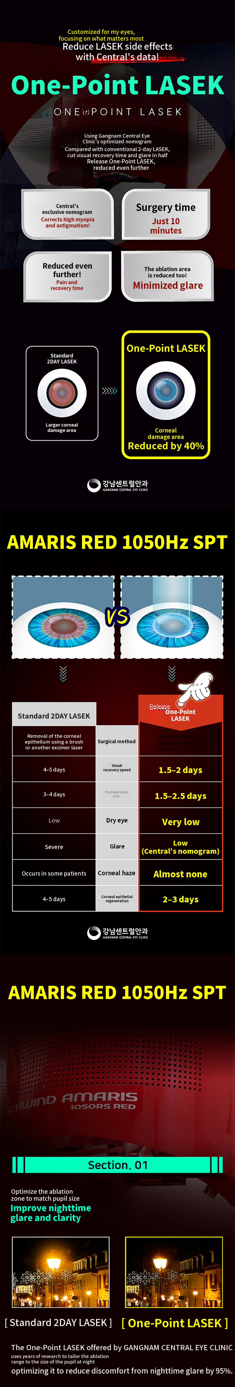 Only 1.5-day recovery, One-Point LASEK