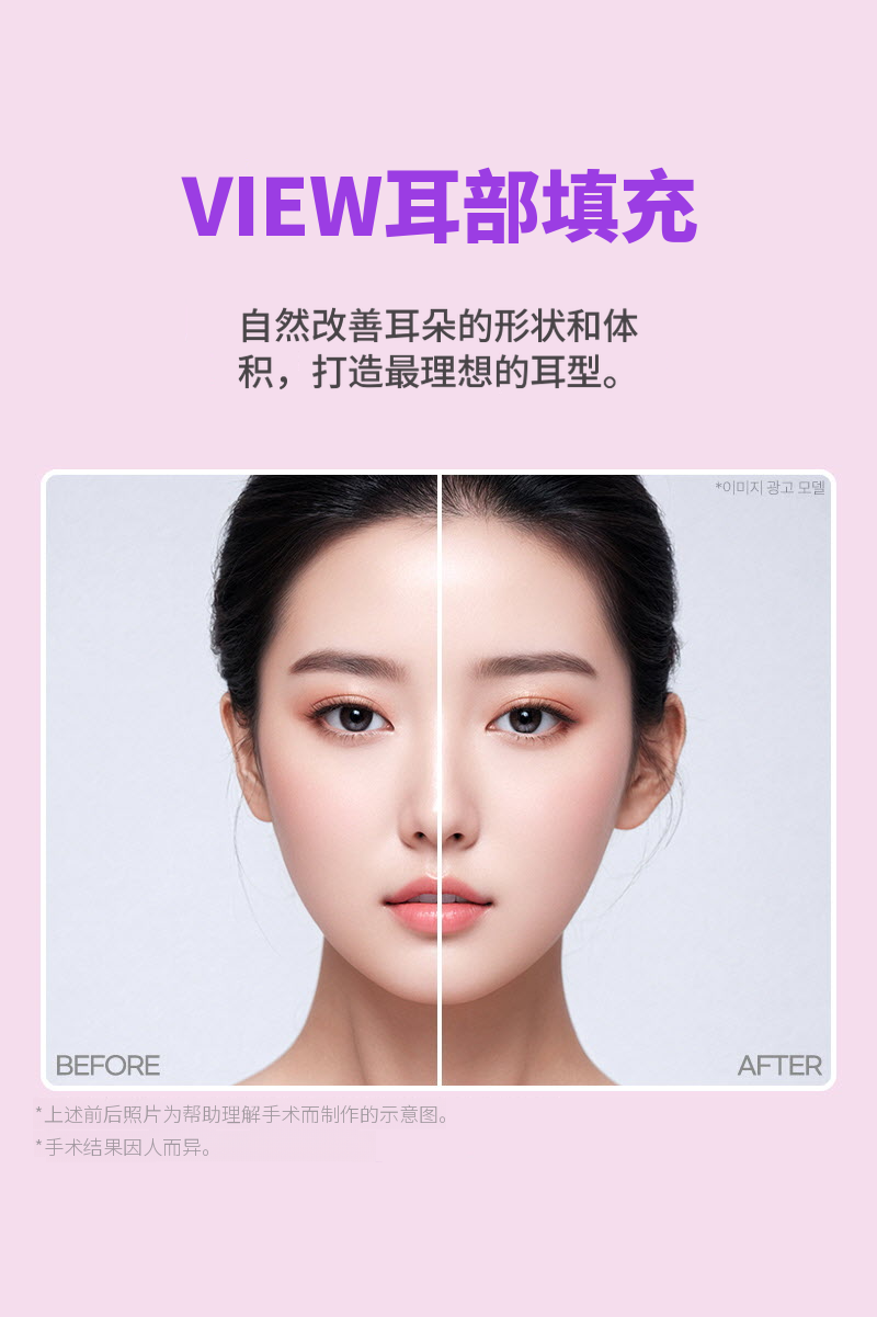 ❤美丽❤耳部填充剂（进口正品）