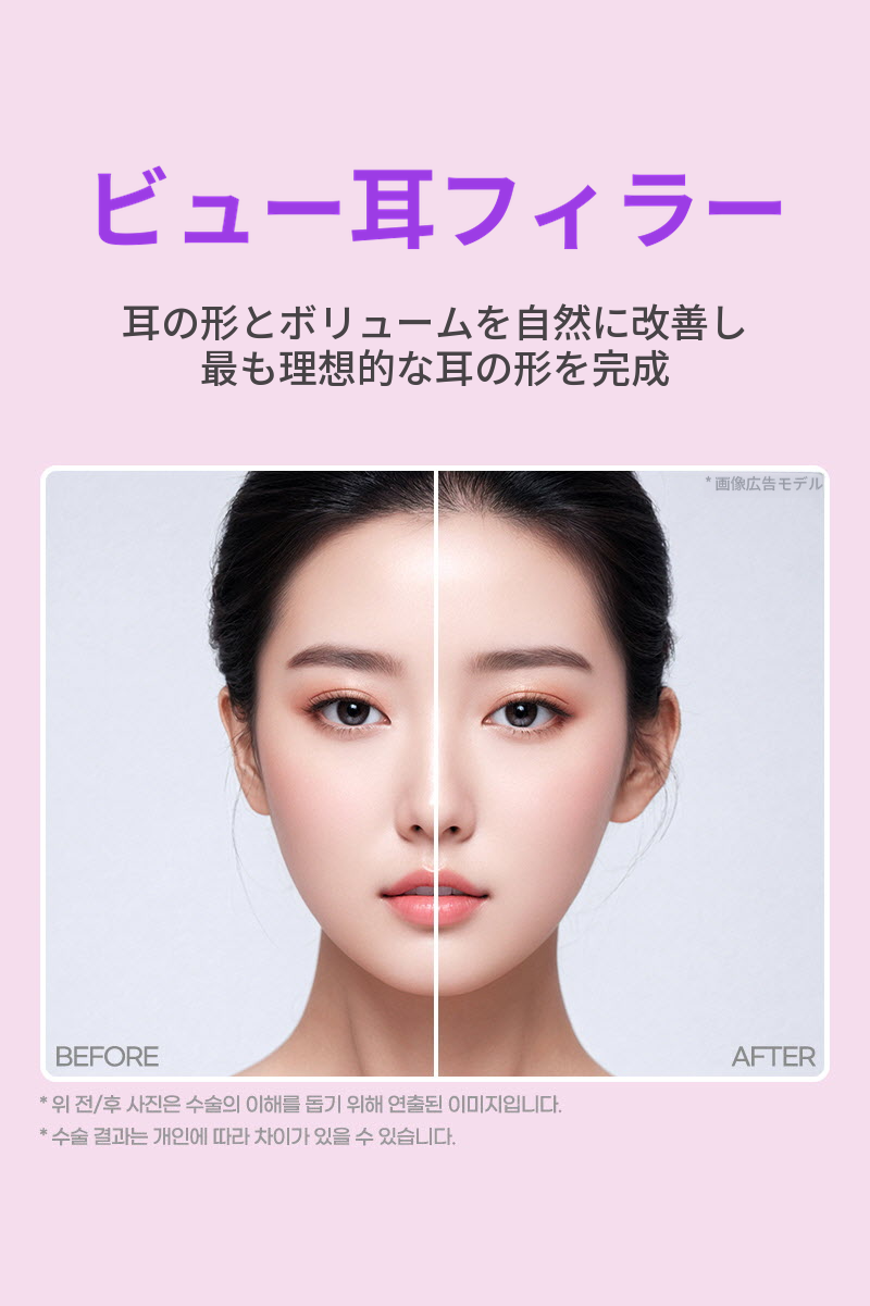 ❤ビュー❤耳フィラー (輸入正品)
