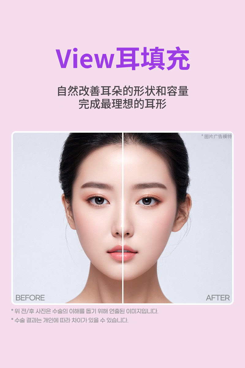 ❤视图❤耳部填充剂 (进口正品)