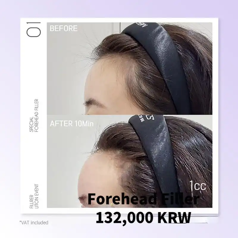 Lift On Forehead Filler