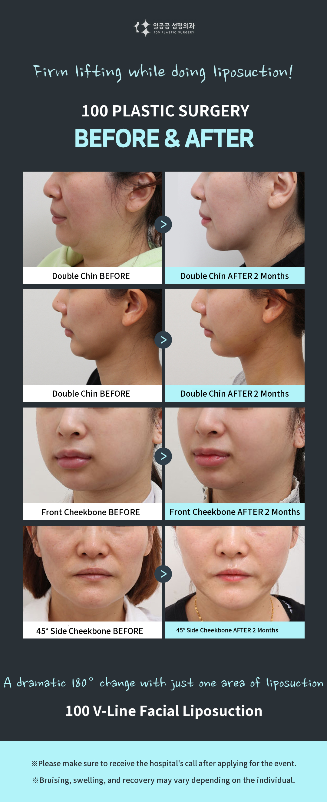 V-Line Facial Liposuction