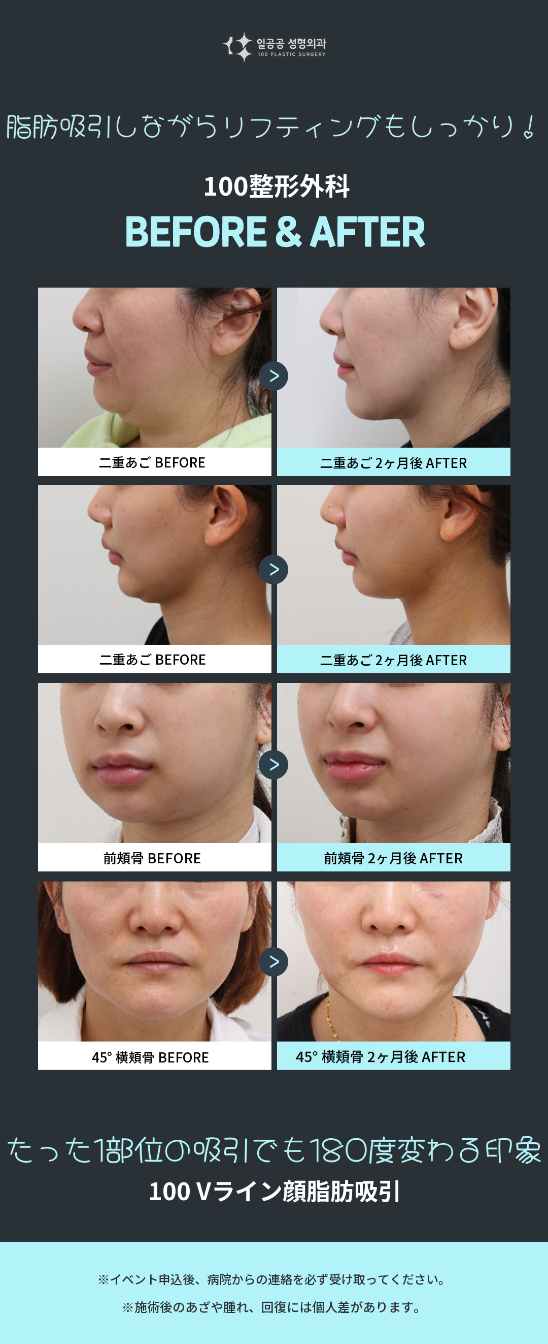 Vライン顔脂肪吸引
