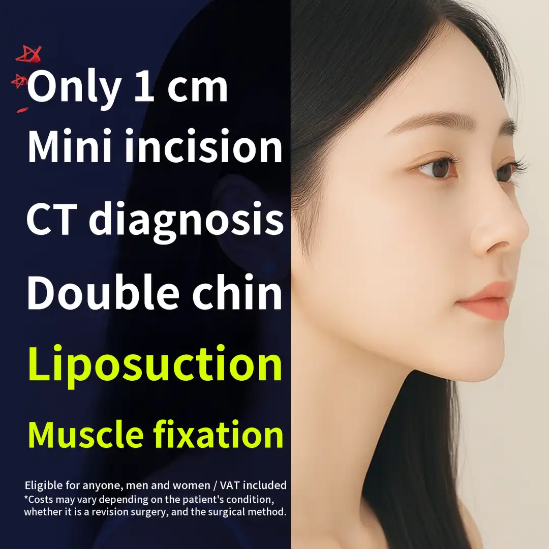 Double chin liposuction, muscle tightening with a 1cm incision, CT diagnosis