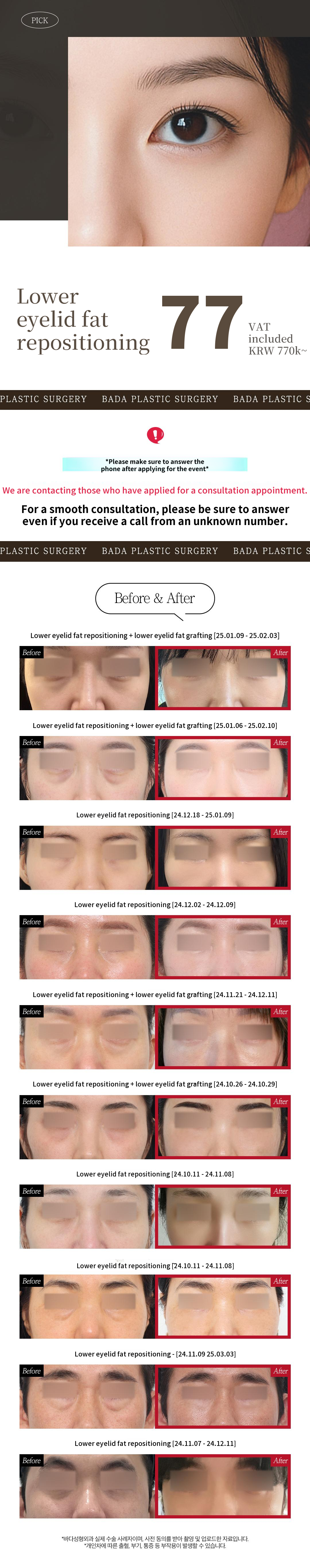 Lower Eyelid Fat Relocation Solutions for Under-Eye Hollows and Bumps