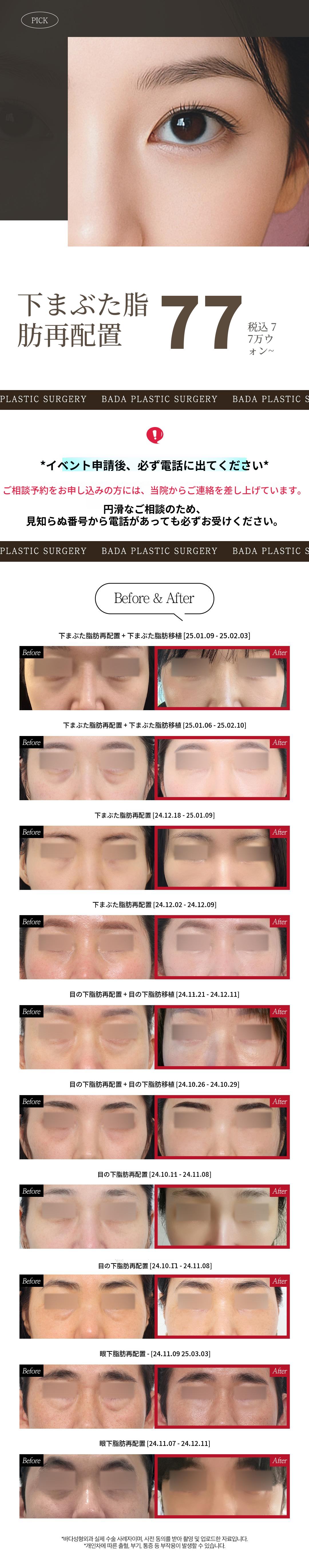 目の下脂肪再配置 目の下のくぼみ、目の下の突出の悩み別ソリューション