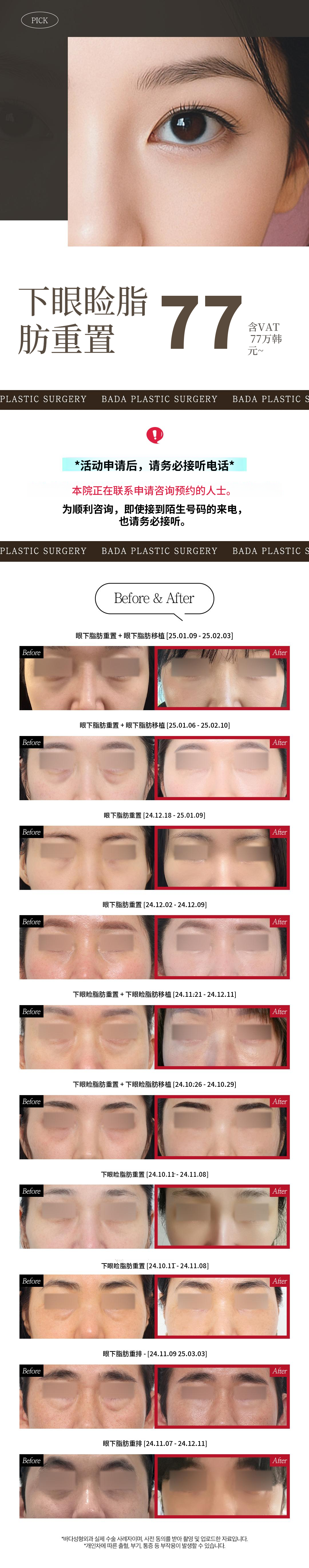 眼下脂肪重塑 眼下凹陷、眼下突出问题解决方案