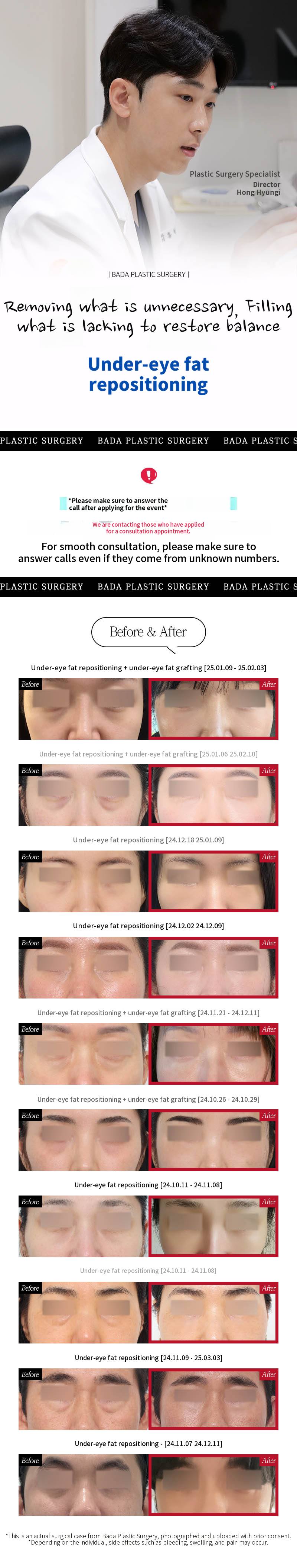 Busan Seomyeon Under-Eye Fat Repositioning_Tailored Solutions for Under-Eye Hollows & Protrusion