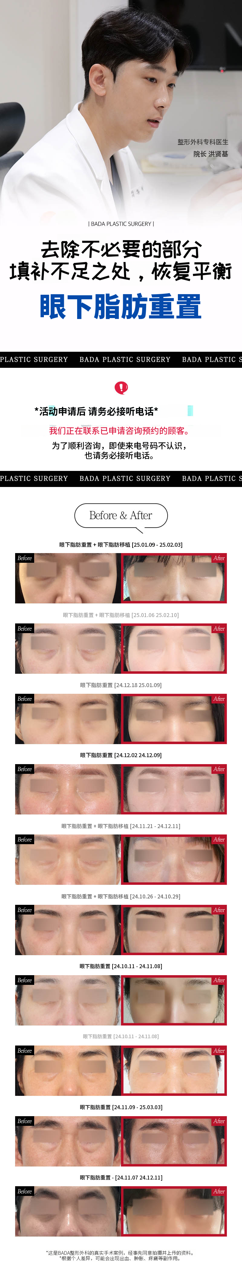 釜山西面眶隔脂肪释放_针对眼下凹陷&突出困扰的个性化解决方案