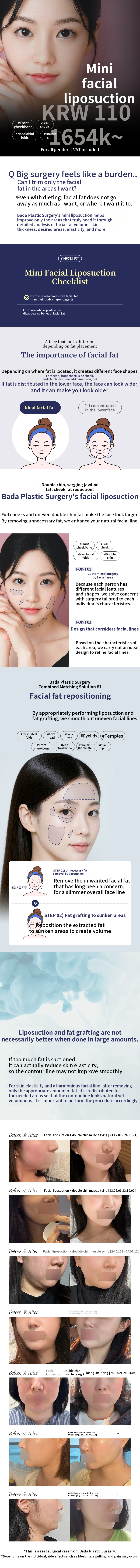 V-Line Mini Facial Liposuction
