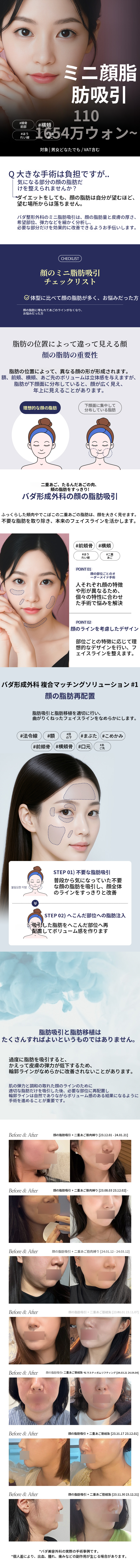 Vラインミニ顔脂肪吸引