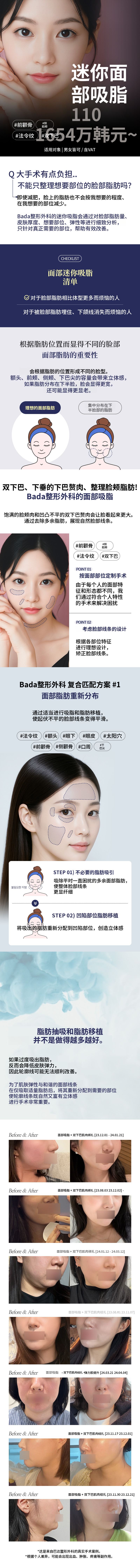 V线迷你面部脂肪抽吸