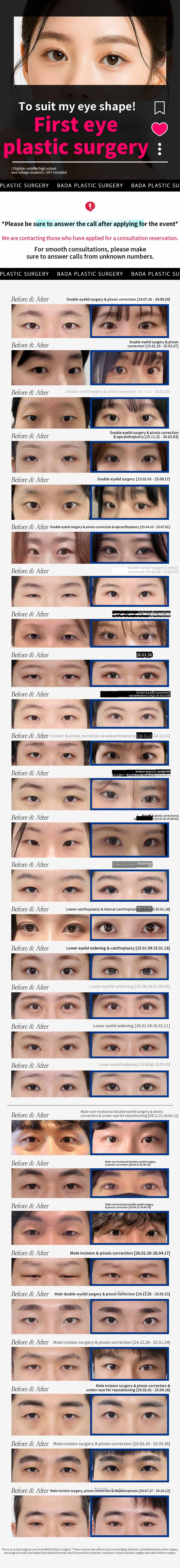 First Snow Cosmetic Surgery Double Eyelid Surgery_Embedding, Incision, Eyelid Correction, Slit