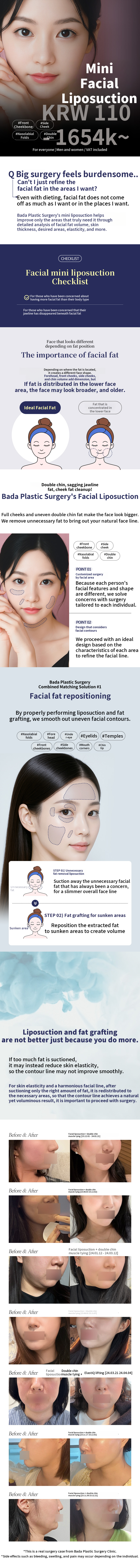 V-Line Mini Facial Liposuction