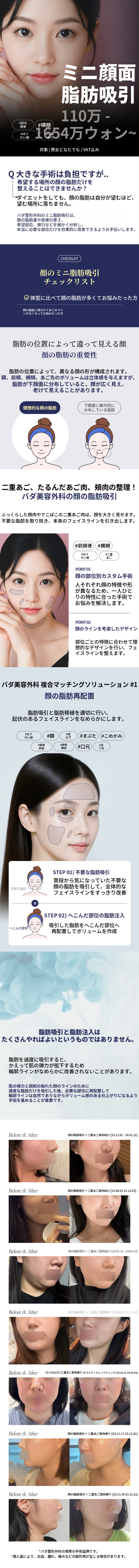 Vラインミニ顔脂肪吸引
