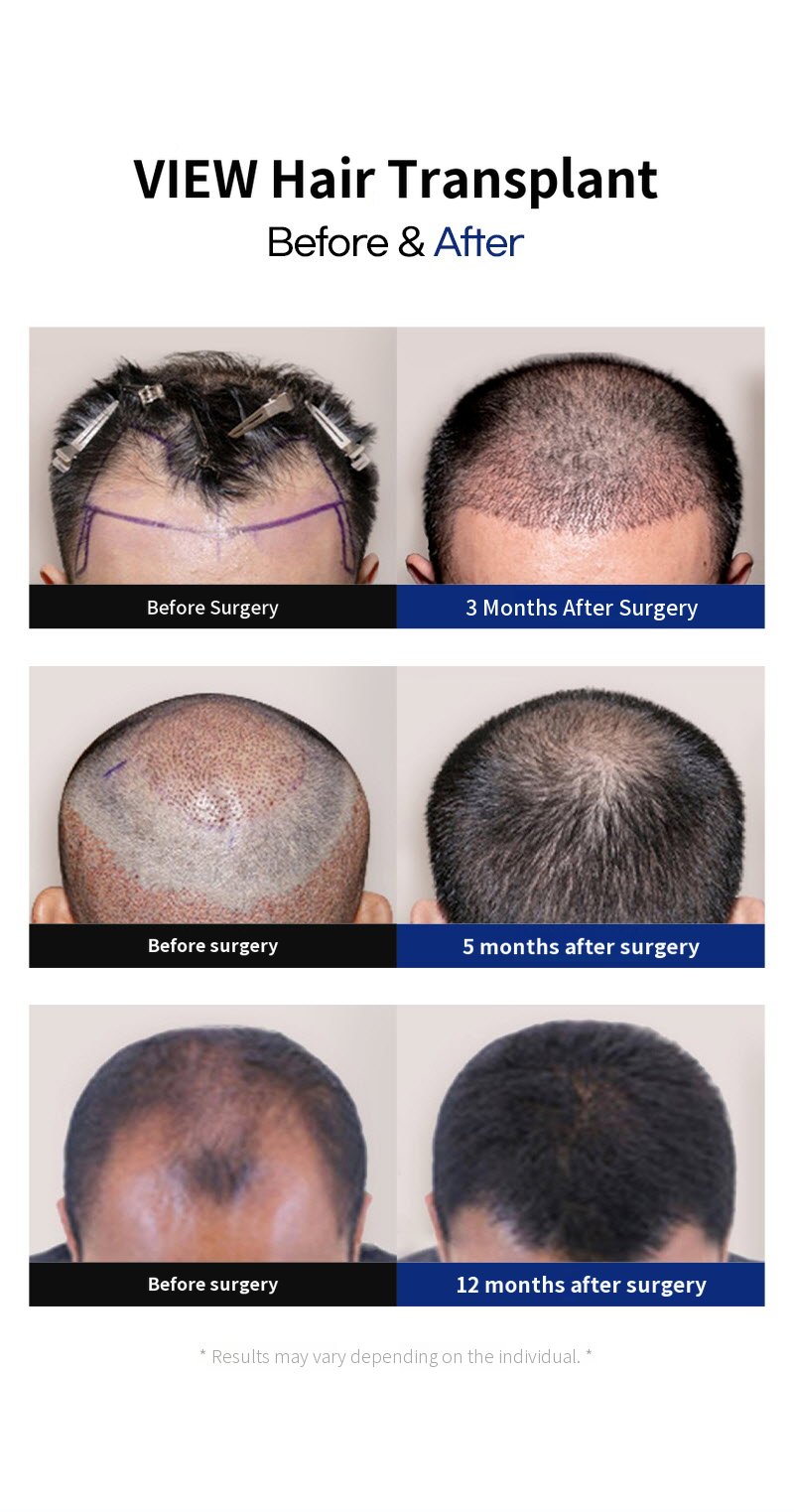 ❤View❤Hair Transplant